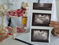 Gejala Kanker Kolorektal Sering Diabaikan, Ini Peringatan untuk Generasi Muda